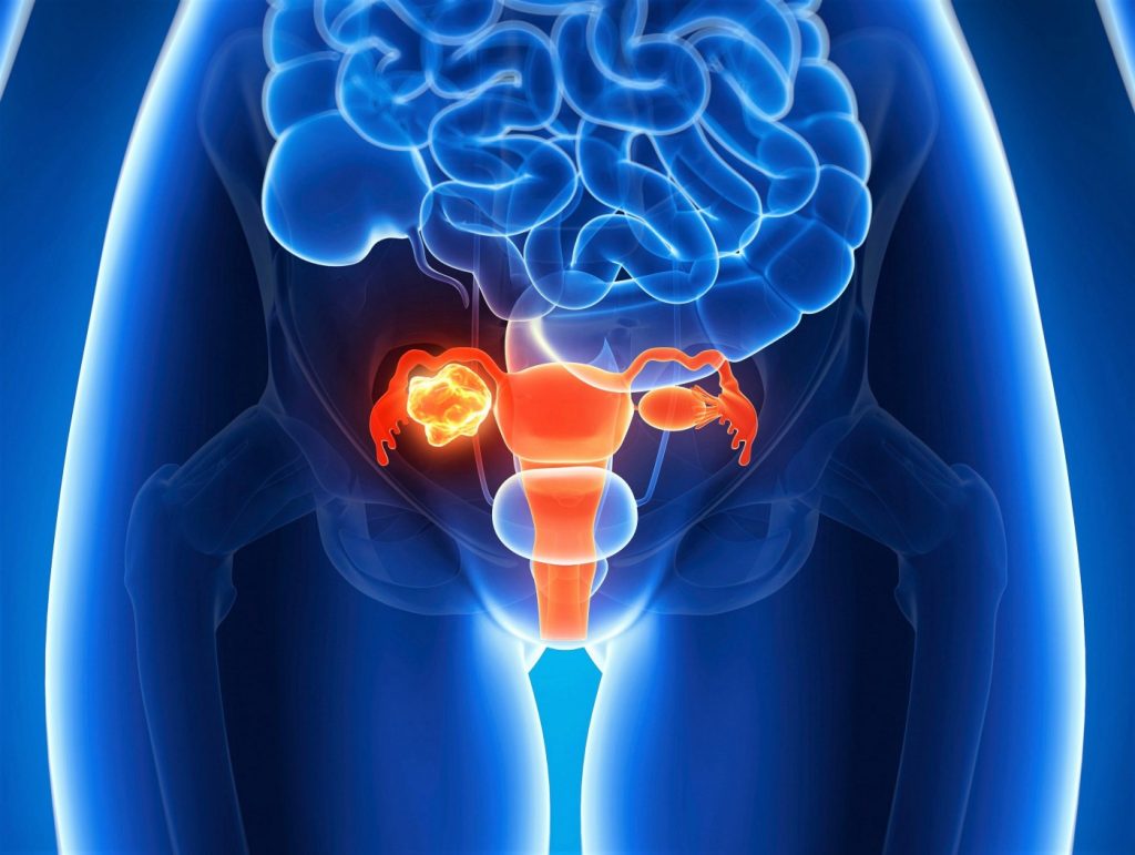 cervical-cancer-causes-signs-treatment